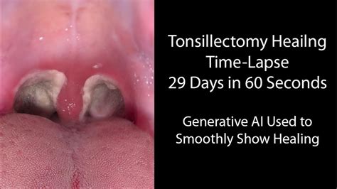 Does Removing Your Tonsils Help with Snoring? And Why Do Astronauts Dream of Silent Nights?